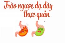Hướng dẫn điều trị trào ngược dạ dày thực quản