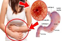 Viêm loét bờ cong nhỏ dạ dày là gì? Điều trị như thế nào?