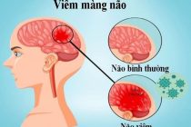 VIÊM MÀNG NÃO DO VI KHUẨN LÀ GÌ?